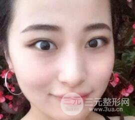 痘坑痘疤要怎么修復(fù)？果酸換膚后臉果圖和真實(shí)案例分享