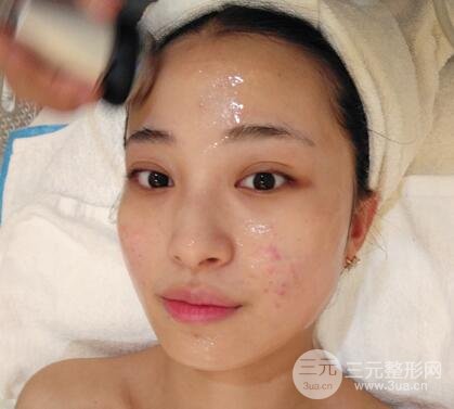 痘坑痘疤要怎么修復(fù)?果酸換膚后臉果圖和真實(shí)案例分享