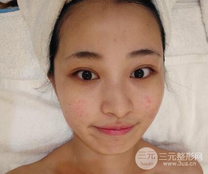 痘坑痘疤要怎么修復(fù)?果酸換膚后臉果圖和真實(shí)案例分享