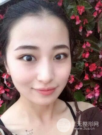 痘坑痘疤要怎么修復(fù)?果酸換膚后臉果圖和真實(shí)案例分享