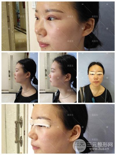 武漢卓美吳秀英雙眼皮+開眼角一個月恢復(fù)對比照片分享~