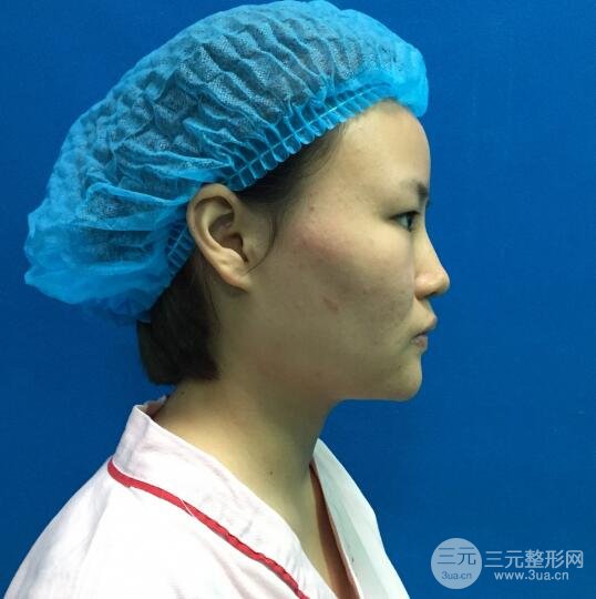 全臉脂肪填充價格 恢復過程圖 真實案例分享