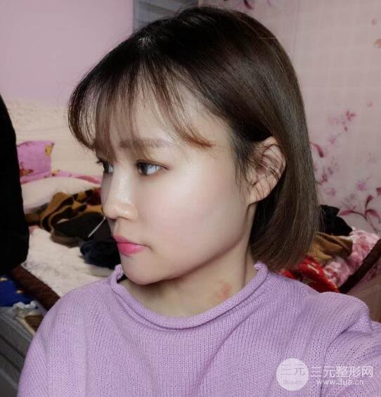 全臉脂肪填充價格 恢復過程圖 真實案例分享