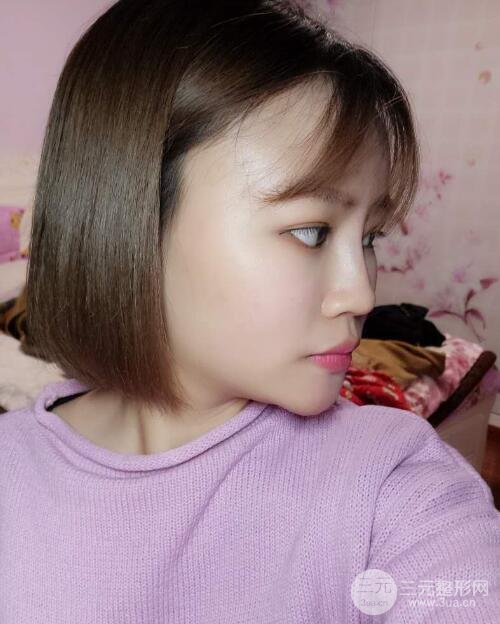 全臉脂肪填充價格 恢復過程圖 真實案例分享