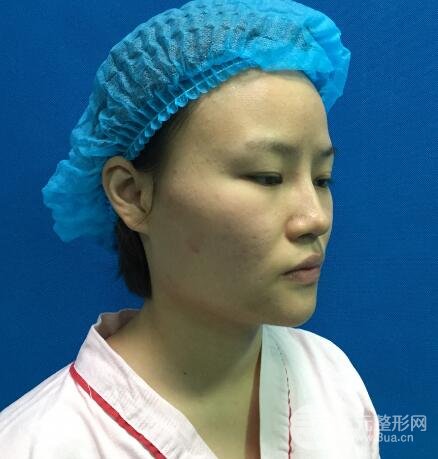 全臉脂肪填充價格 恢復過程圖 真實案例分享