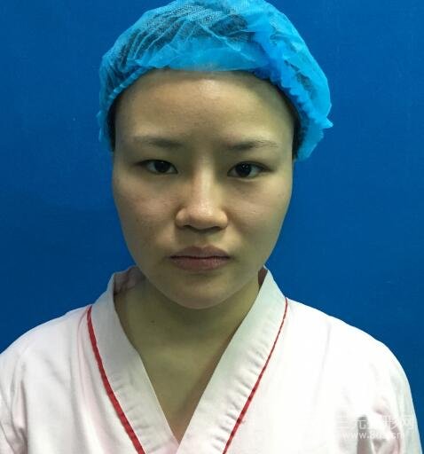全臉脂肪填充價格 恢復過程圖 真實案例分享