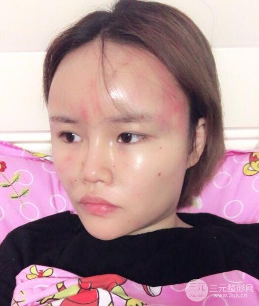 全臉脂肪填充價格 恢復過程圖 真實案例分享