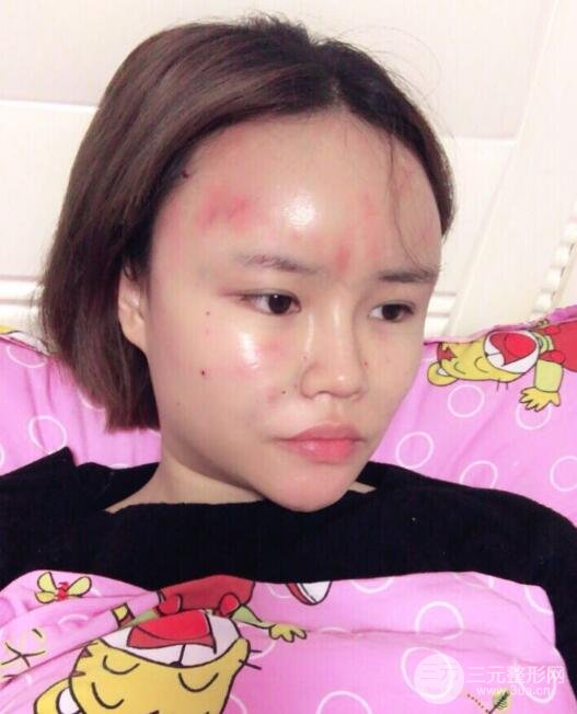 全臉脂肪填充價格 恢復過程圖 真實案例分享