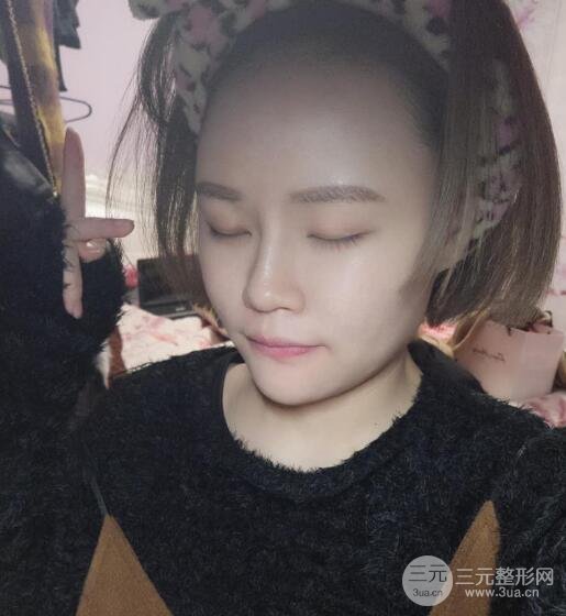 全臉脂肪填充價格 恢復過程圖 真實案例分享