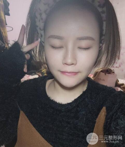 全臉脂肪填充價格 恢復過程圖 真實案例分享