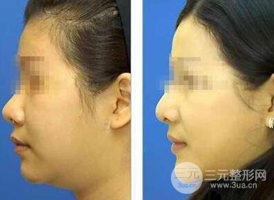 面部吸脂大概要多少錢？面部吸脂減肥價(jià)格表和前后果圖片