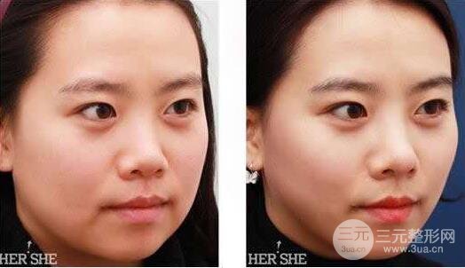 面部吸脂大概要多少錢？面部吸脂減肥價(jià)格表和前后果圖片