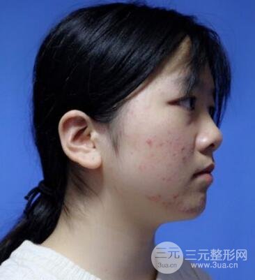 怎樣減掉雙下巴？雙下巴吸脂后個人經(jīng)歷 價格略貴但果好