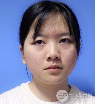 怎樣減掉雙下巴？雙下巴吸脂后個人經(jīng)歷 價格略貴但果好