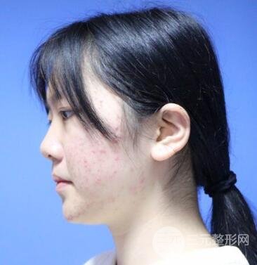 怎樣減掉雙下巴？雙下巴吸脂后個人經(jīng)歷 價格略貴但果好