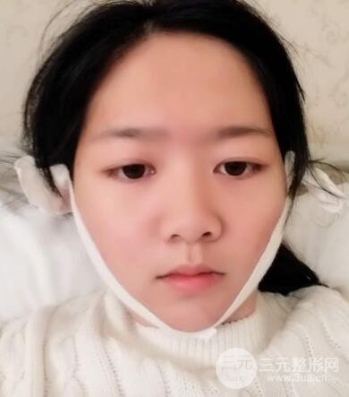 怎樣減掉雙下巴？雙下巴吸脂后個人經(jīng)歷 價格略貴但果好