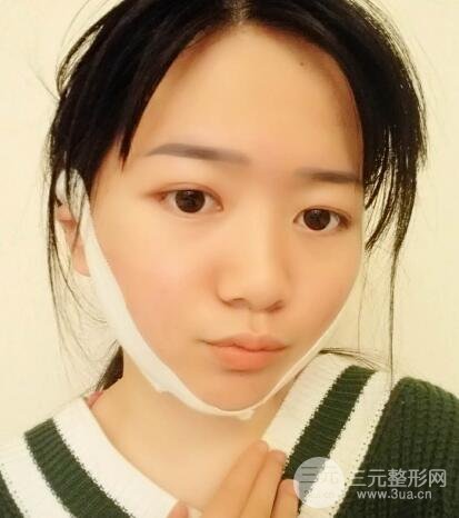 怎樣減掉雙下巴？雙下巴吸脂后個人經(jīng)歷 價格略貴但果好