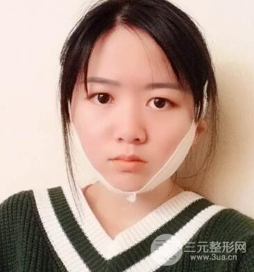 怎樣減掉雙下巴？雙下巴吸脂后個人經(jīng)歷 價格略貴但果好
