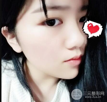 怎樣減掉雙下巴？雙下巴吸脂后個人經(jīng)歷 價格略貴但果好