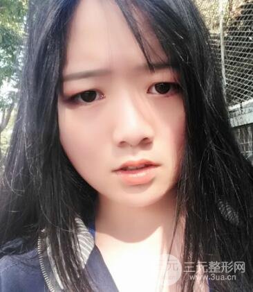 怎樣減掉雙下巴？雙下巴吸脂后個人經(jīng)歷 價格略貴但果好