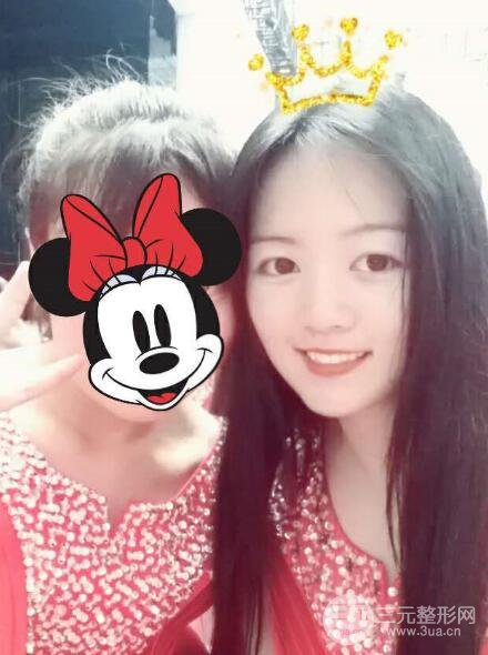 怎樣減掉雙下巴？雙下巴吸脂后個人經(jīng)歷 價格略貴但果好