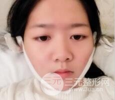 怎樣減掉雙下巴？雙下巴吸脂后個人經(jīng)歷 價格略貴但果好