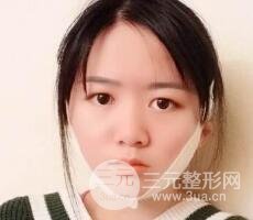 怎樣減掉雙下巴？雙下巴吸脂后個人經(jīng)歷 價格略貴但果好