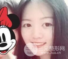 怎樣減掉雙下巴？雙下巴吸脂后個人經(jīng)歷 價格略貴但果好