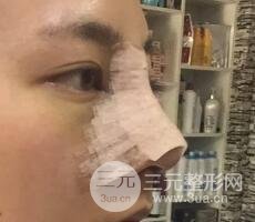 耳軟骨墊鼻尖+假體隆鼻恢復(fù)過程實例和價格圖片分享