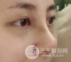 耳軟骨墊鼻尖+假體隆鼻恢復(fù)過程實例和價格圖片分享