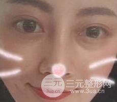 耳軟骨墊鼻尖+假體隆鼻恢復(fù)過程實例和價格圖片分享
