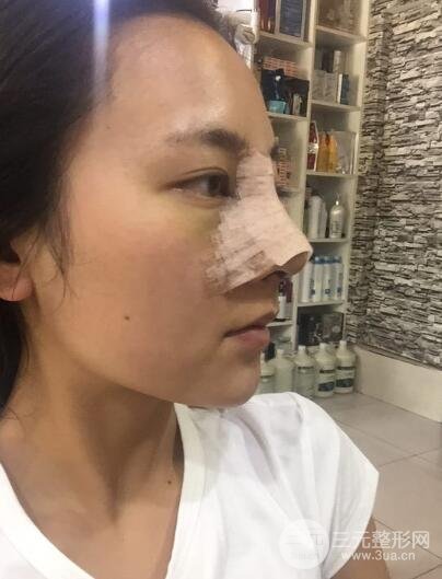 耳軟骨墊鼻尖+假體隆鼻恢復(fù)過程實(shí)例和價(jià)格圖片分享