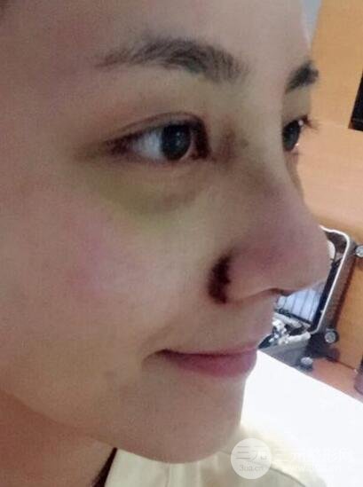 耳軟骨墊鼻尖+假體隆鼻恢復(fù)過程實(shí)例和價(jià)格圖片分享