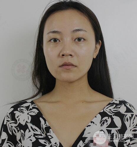 耳軟骨墊鼻尖+假體隆鼻恢復(fù)過程實(shí)例和價(jià)格圖片分享