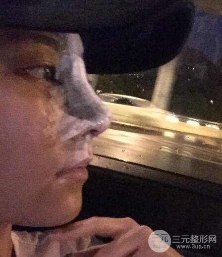 耳軟骨墊鼻尖+假體隆鼻恢復(fù)過程實(shí)例和價(jià)格圖片分享