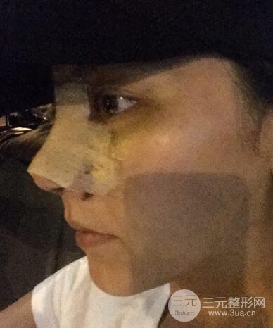 耳軟骨墊鼻尖+假體隆鼻恢復(fù)過程實(shí)例和價(jià)格圖片分享