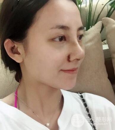耳軟骨墊鼻尖+假體隆鼻恢復(fù)過程實(shí)例和價(jià)格圖片分享