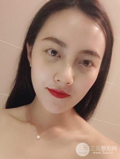 耳軟骨墊鼻尖+假體隆鼻恢復(fù)過程實(shí)例和價(jià)格圖片分享