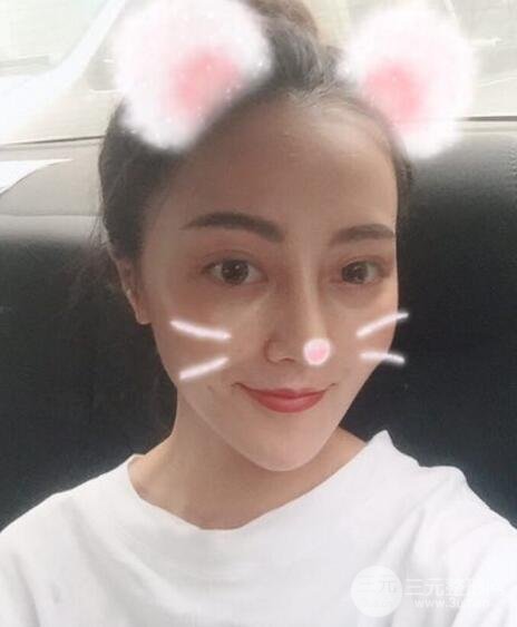 耳軟骨墊鼻尖+假體隆鼻恢復(fù)過程實(shí)例和價(jià)格圖片分享