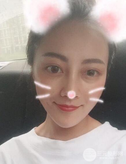 耳軟骨墊鼻尖+假體隆鼻恢復(fù)過程實(shí)例和價(jià)格圖片分享