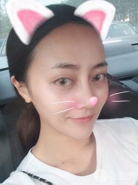 耳軟骨墊鼻尖+假體隆鼻恢復(fù)過程實(shí)例和價(jià)格圖片分享