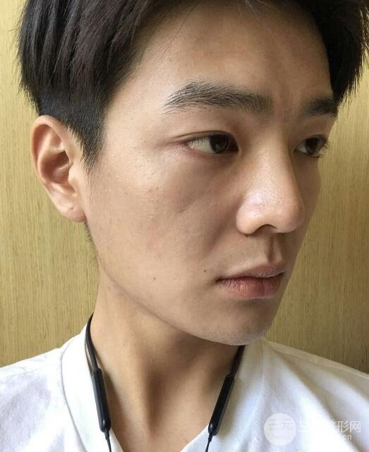 高強(qiáng)度聚焦超聲面b提升術(shù)多少錢(qián)?親身經(jīng)歷案例