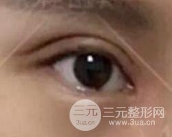 割歐式雙眼皮價(jià)格和案例