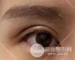 割歐式雙眼皮價(jià)格和案例