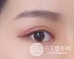 割歐式雙眼皮價(jià)格和案例