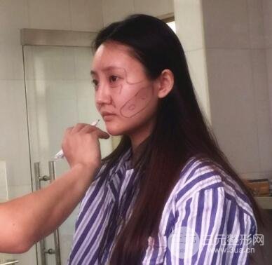 自體脂肪面部填充價位和案例