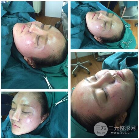 自體脂肪面部填充價位和案例