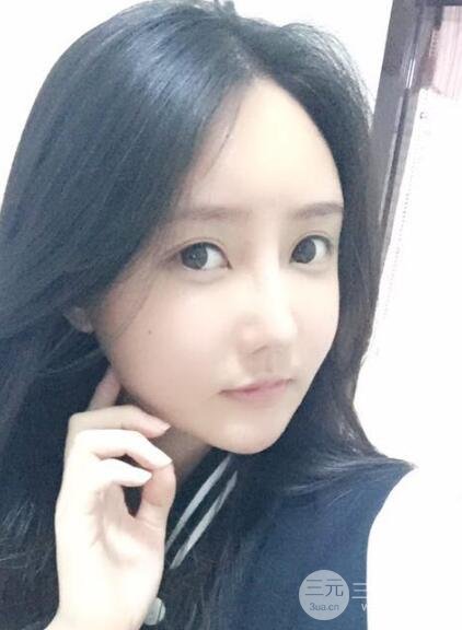 自體脂肪面部填充價位和案例