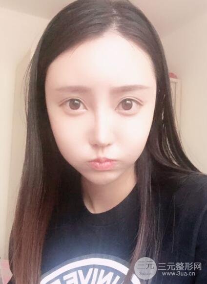 自體脂肪面部填充價位和案例