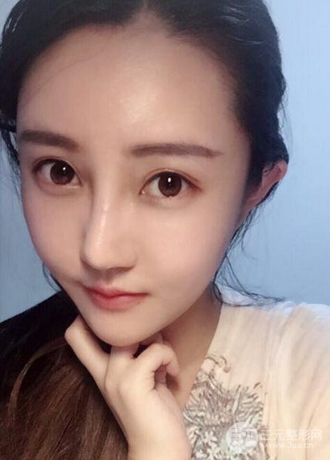 自體脂肪面部填充價位和案例